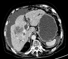 肝内胆管细胞癌