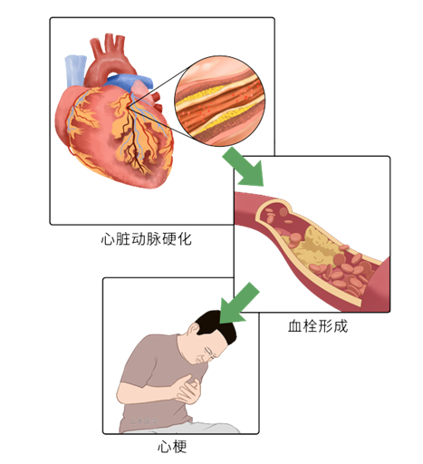 「科普」冠心病全面防治手册：从认知到行动，关注心脏健康